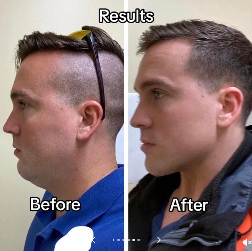 Tiktok trend showing before and after 'mewing'